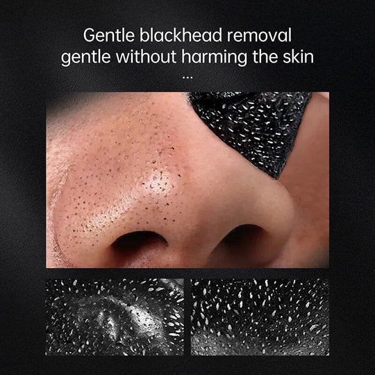 Ultimate Blackhead Removal Mask