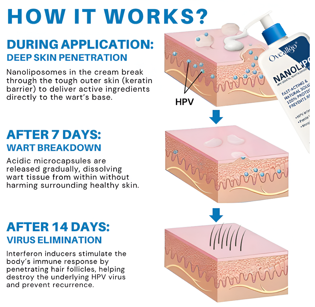 Oveallgo® NanoLipo HPV Genital Warts Eraser Cream Pro