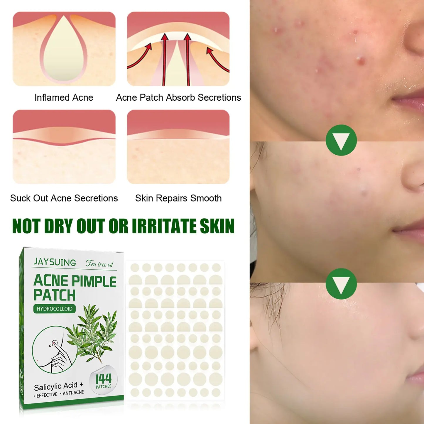 Acne Pimple Patches